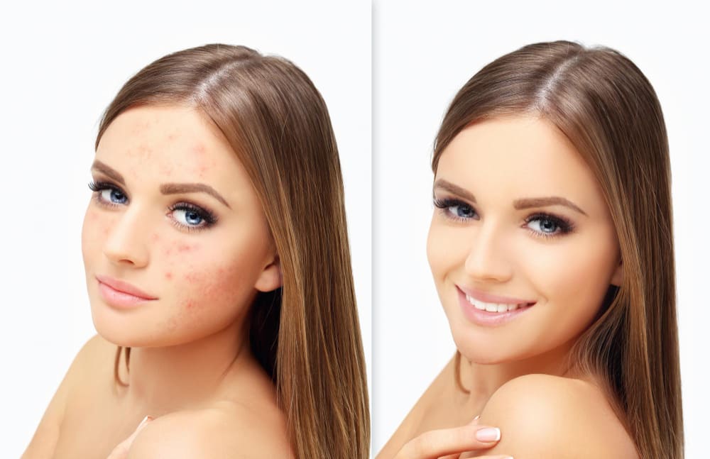 Microneedling: Rejuvenecimiento Facial y Tratamiento de Cicatrices